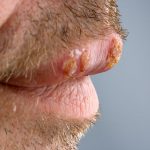 An explanation of the four cold sore stages and the symptoms of each stage