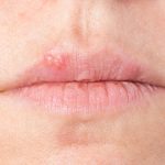 An explanation of what causes cold sores