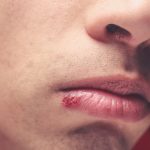 What is a cold sore and how do you prevent them?