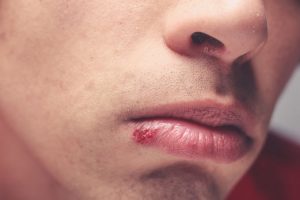 What is a cold sore and how do you prevent them?
