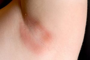 Some possible causes of an itchy underarm rash